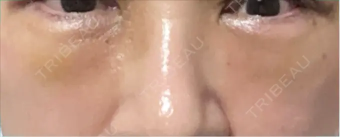 下まぶたの脂肪取り 博多もへじのクリニック DAY 2 メイン用