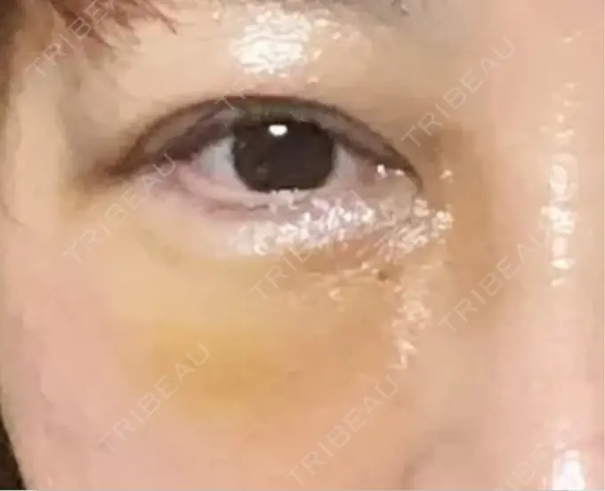 下まぶたの脂肪取り 博多もへじのクリニック DAY 2 メイン用