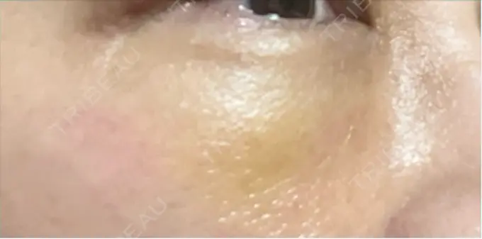 下まぶたの脂肪取り 博多もへじのクリニック DAY 3 メイン用