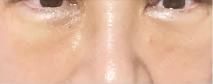 下まぶたの脂肪取り 博多もへじのクリニック DAY 6 メイン用