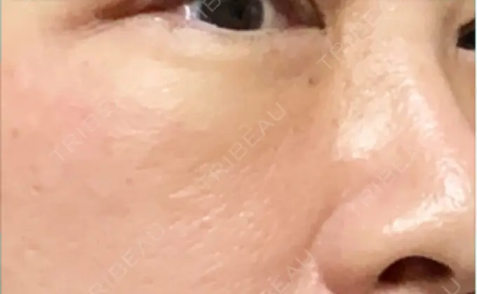 下まぶたの脂肪取り 博多もへじのクリニック DAY 7 メイン用