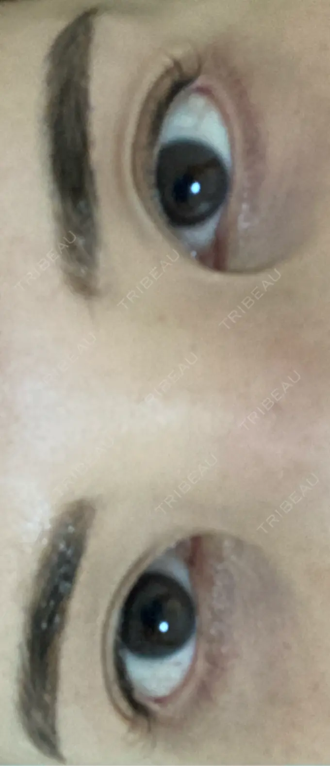 その他（目元） ルーチェクリニック 銀座院 DAY 3 メイン用