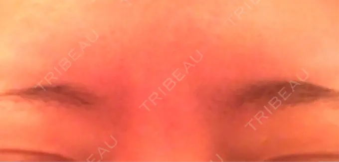 ボトックス（眉間） 湘南美容クリニック 名古屋栄院 DAY 2 メイン用