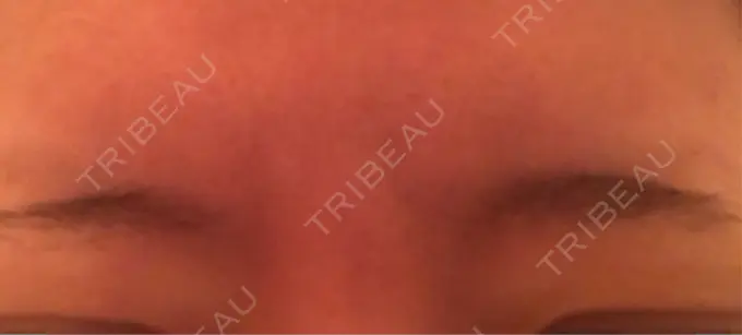 ボトックス（眉間） 湘南美容クリニック 名古屋栄院 DAY 3 メイン用