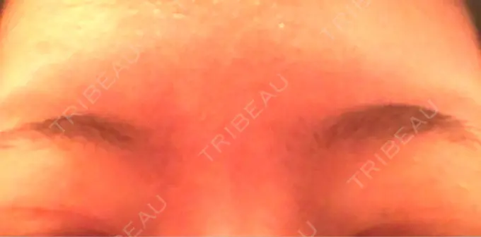 ボトックス（眉間） 湘南美容クリニック 名古屋栄院 DAY 4 メイン用