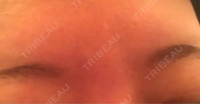 ボトックス（眉間） 湘南美容クリニック 名古屋栄院 DAY 6 メイン用