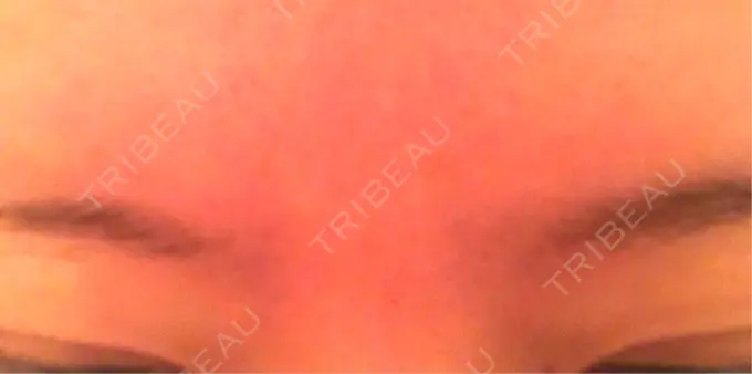 ボトックス（眉間） 湘南美容クリニック 名古屋栄院 DAY 7 メイン用