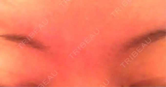 ボトックス（眉間） 湘南美容クリニック 名古屋栄院 DAY 8 メイン用