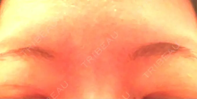 ボトックス（眉間） 湘南美容クリニック 名古屋栄院 DAY 9 メイン用