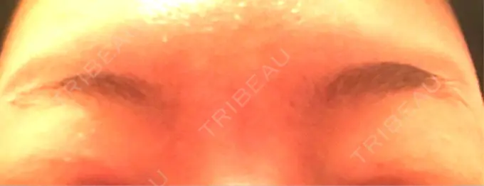 ボトックス（眉間） 湘南美容クリニック 名古屋栄院 AFTER メイン用