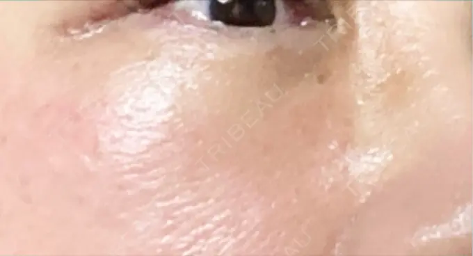 下まぶたの脂肪取り 博多もへじのクリニック DAY 11 メイン用