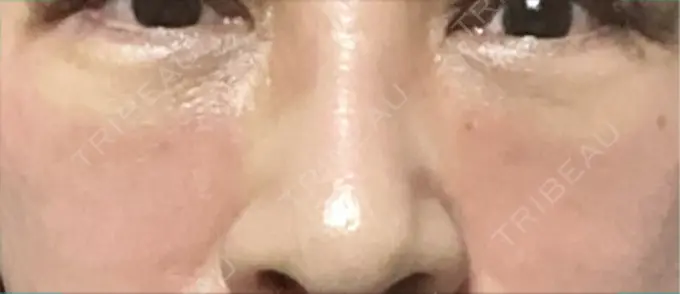 下まぶたの脂肪取り 博多もへじのクリニック DAY 11 メイン用