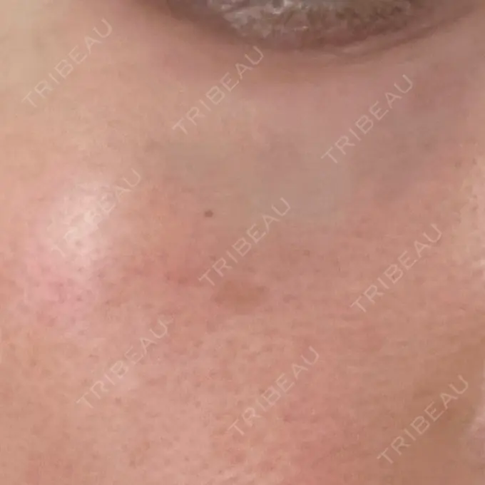 リジュラン 湘南美容クリニック 広島院 DAY 2 メイン用