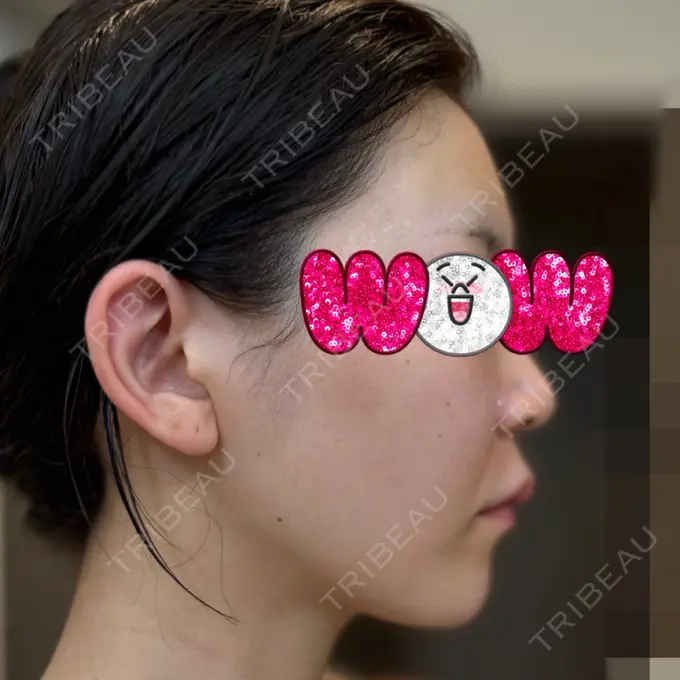 ヒアルロン酸注入（額） / ヒアルロン酸注入（頬） / ヒアルロン酸注入（鼻翼基部） KIMI CLINIC 形成・美容外科 DAY 11 メイン用