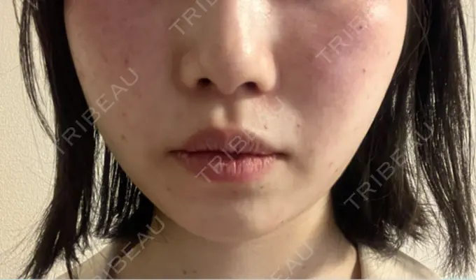 ルビーレーザー Designo Clinic （デジーノクリニック） DAY 0 メイン用