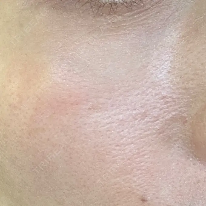 リジュラン 湘南美容クリニック 広島院 DAY 3 メイン用