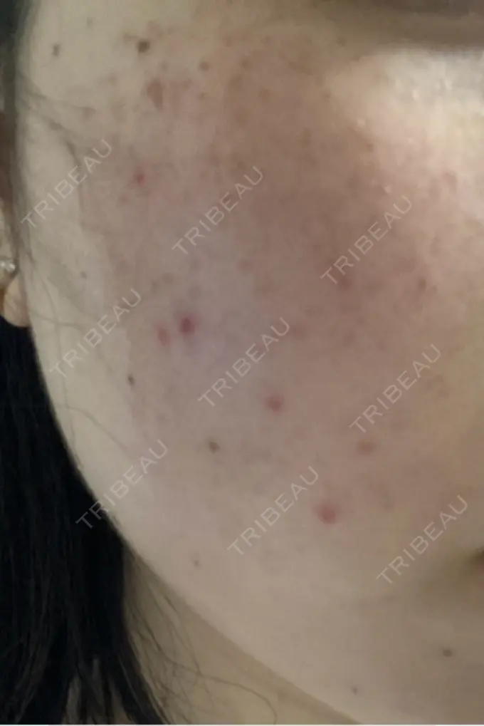 ルビーレーザー Designo Clinic （デジーノクリニック） DAY 1 メイン用