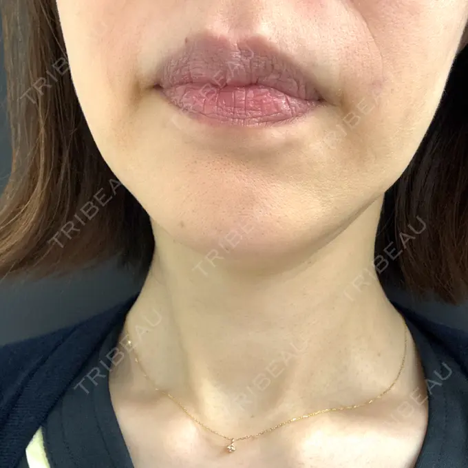 ハイフ（顔） 東京美容外科 福岡院 AFTER メイン用