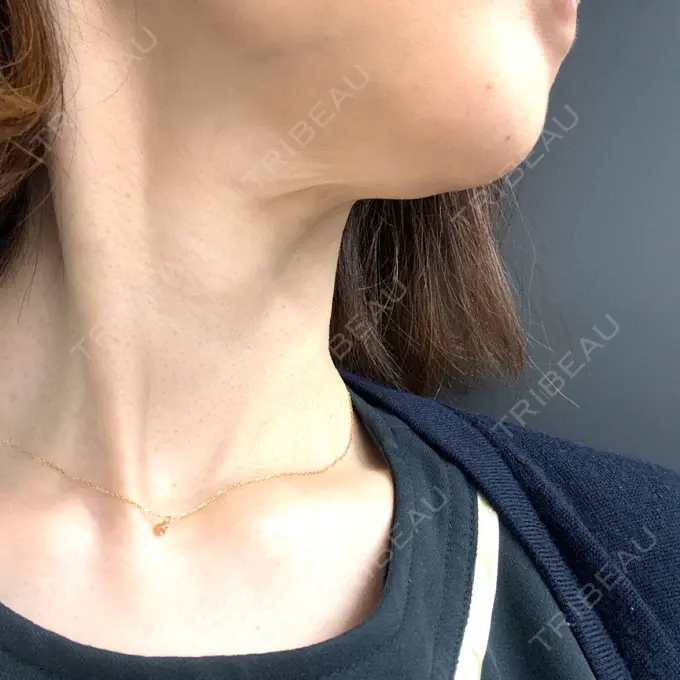 ハイフ（顔） 東京美容外科 福岡院 DAY 4 メイン用