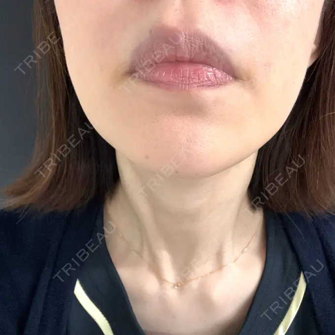 ハイフ（顔） 東京美容外科 福岡院 DAY 4 メイン用