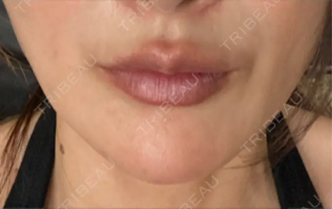 切開リフト GRACY TOKYO CLINIC【グレイシートウキョウクリニック】 DAY 0 メイン用