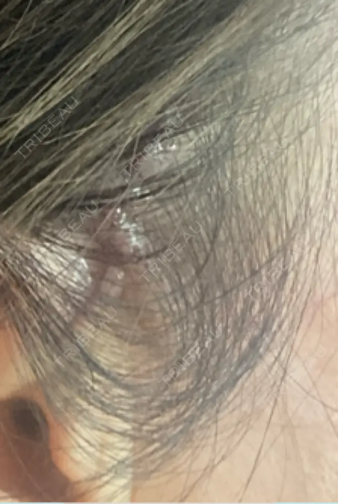 切開リフト GRACY TOKYO CLINIC【グレイシートウキョウクリニック】 DAY 0 メイン用