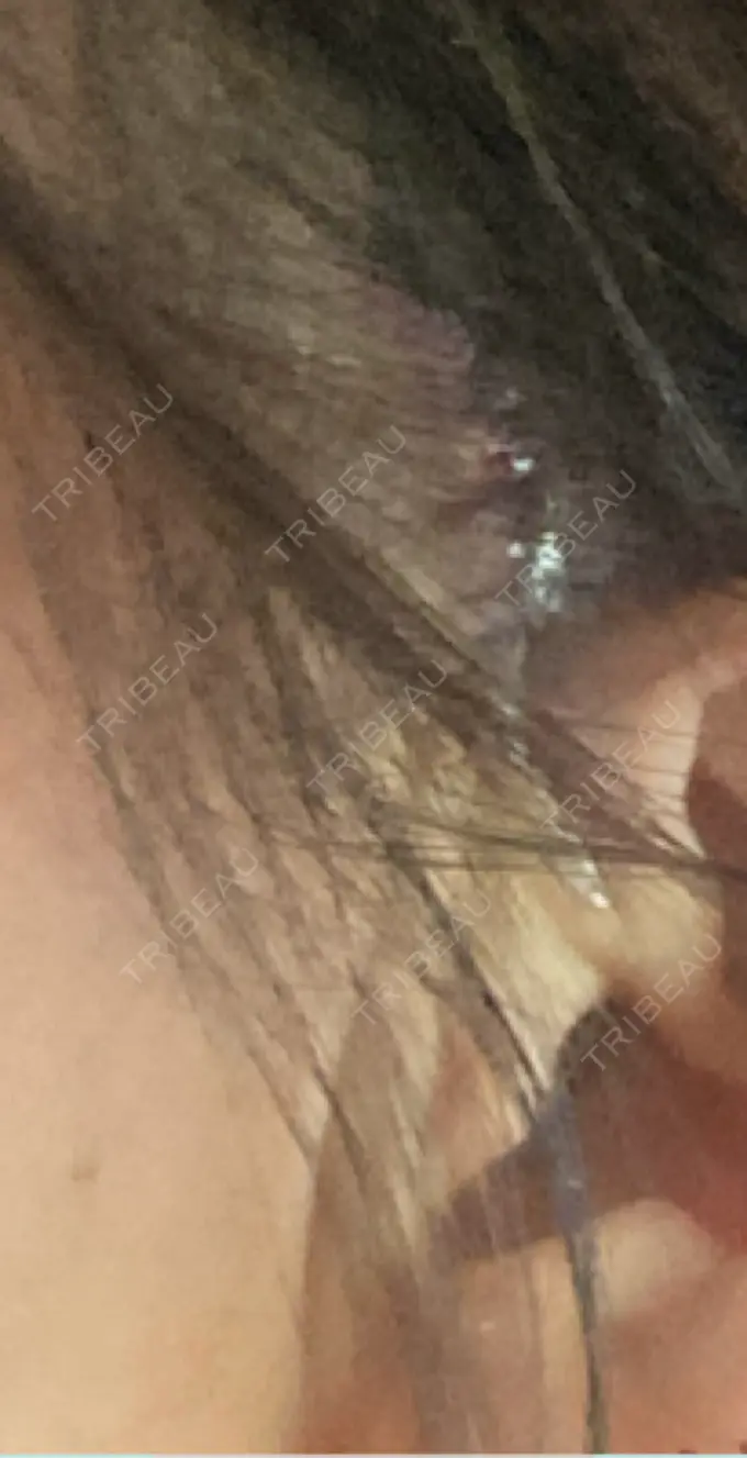 切開リフト GRACY TOKYO CLINIC【グレイシートウキョウクリニック】 DAY 0 メイン用