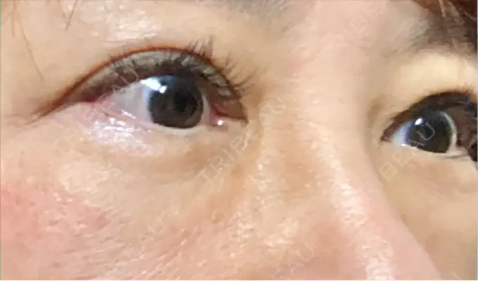 下まぶたの脂肪取り 博多もへじのクリニック AFTER メイン用