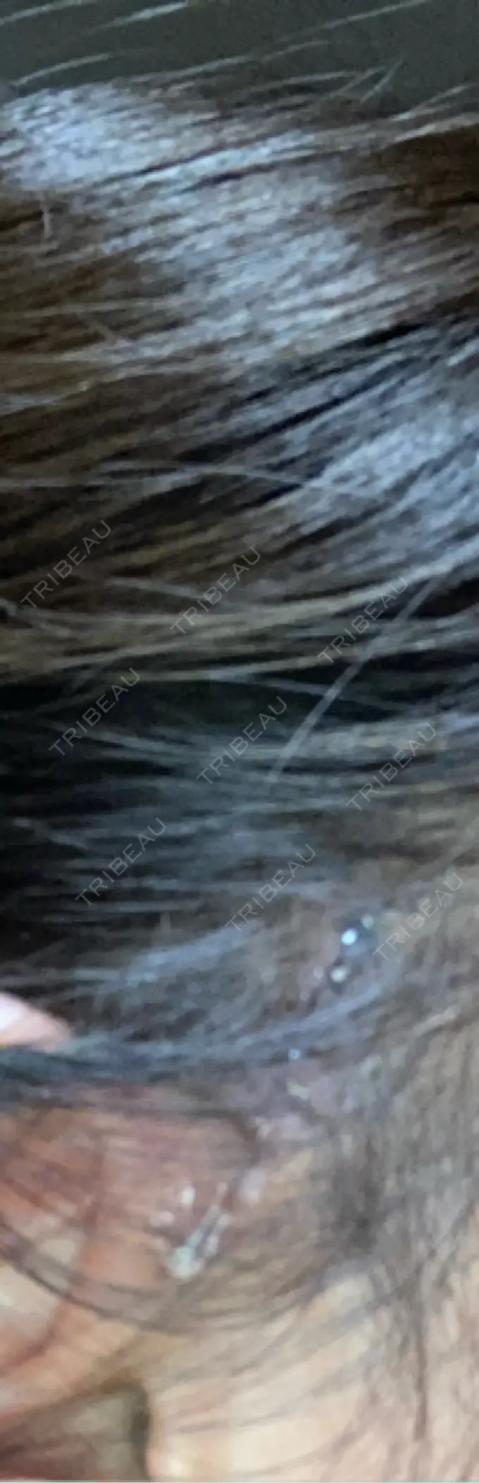 切開リフト GRACY TOKYO CLINIC【グレイシートウキョウクリニック】 DAY 1 メイン用