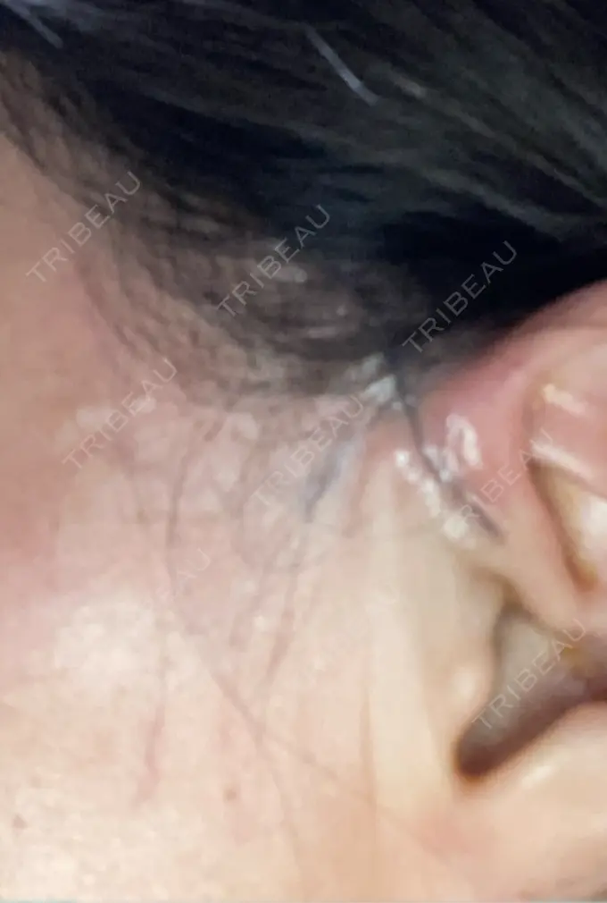 切開リフト GRACY TOKYO CLINIC【グレイシートウキョウクリニック】 DAY 1 メイン用