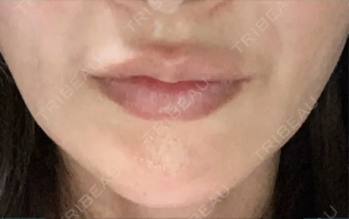 切開リフト GRACY TOKYO CLINIC【グレイシートウキョウクリニック】 DAY 1 メイン用