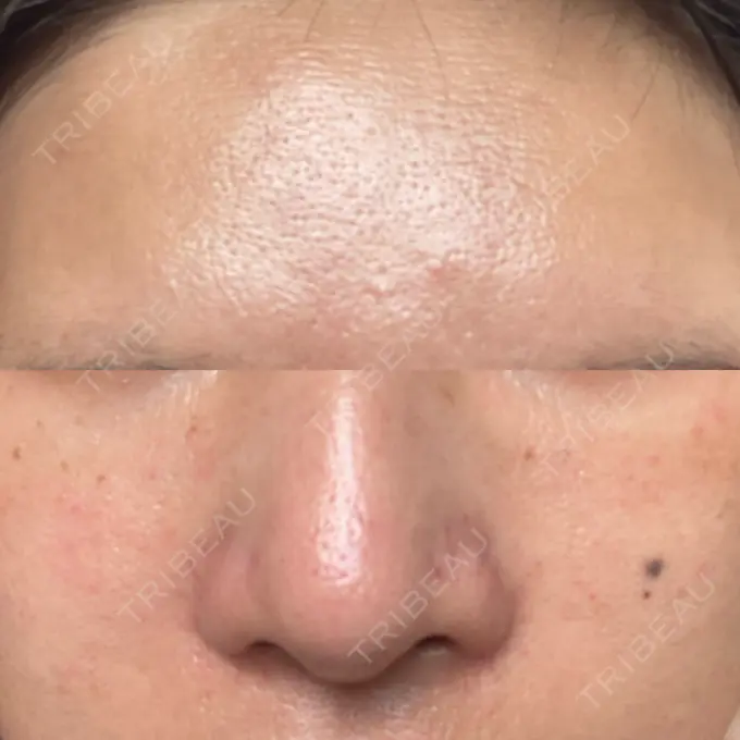 マイクロボトックス 東京シルククリニック 新宿院 DAY 1 メイン用