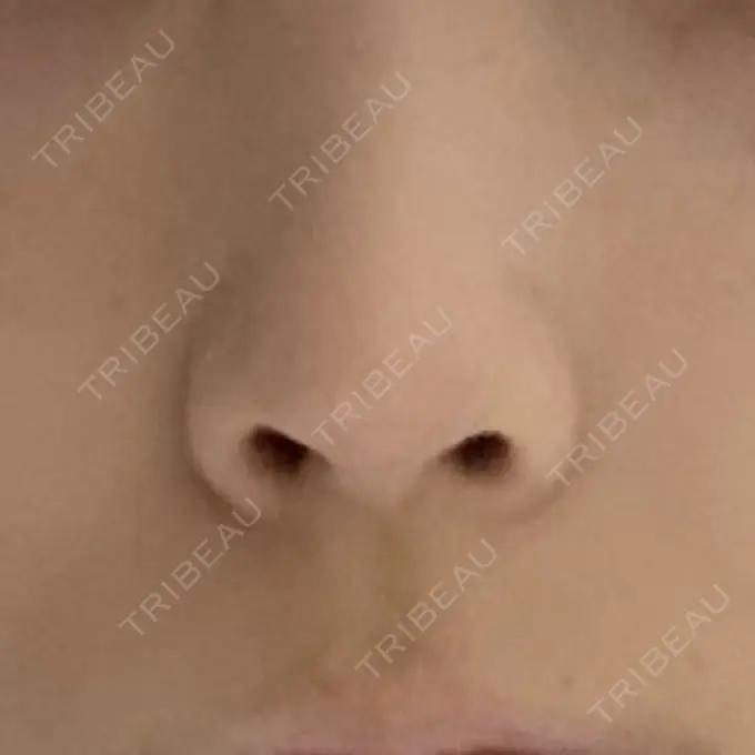 鼻孔縁下降 / その他（鼻） 聖心美容クリニック 銀座院 DAY 49 メイン用