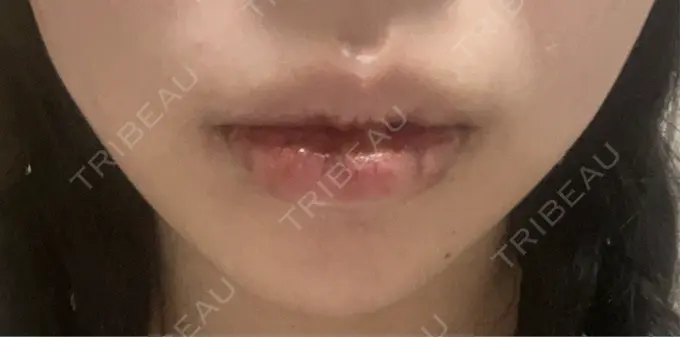 口唇縮小術 B-LINE CLINIC 池袋院 DAY 5 メイン用