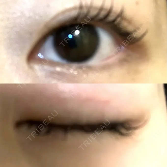 二重埋没 水の森美容クリニック 名古屋院 DAY 13 メイン用