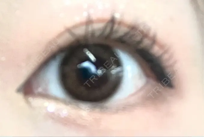 二重埋没 水の森美容クリニック 名古屋院 AFTER メイン用