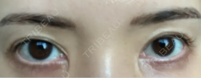 その他（目元） ルーチェクリニック 銀座院 AFTER メイン用