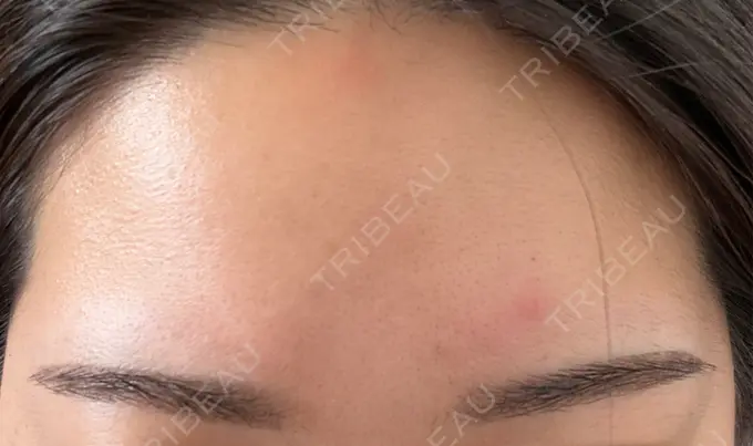 ボトックス（エラ・小顔） / アートメイク（眉） ミケイ医院 AFTER メイン用