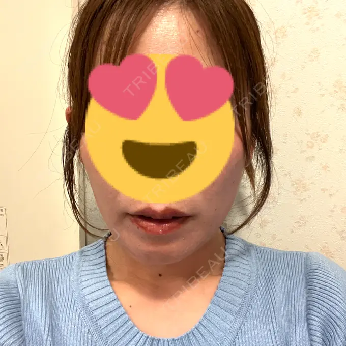 ボトックス（エラ・小顔） / ボトックス（目尻） TCB東京中央美容外科 水戸院 DAY 1 メイン用