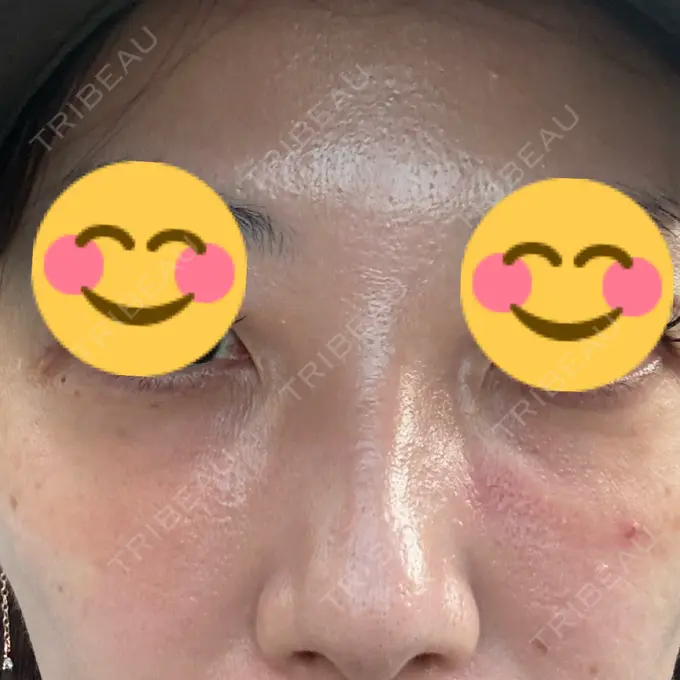 肌育注射（ジュベルックなど） / その他（肌） ゆきスキンクリニック 東池袋 DAY 0 メイン用