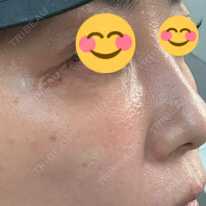 肌育注射（ジュベルックなど） / その他（肌） ゆきスキンクリニック 東池袋 DAY 0 メイン用