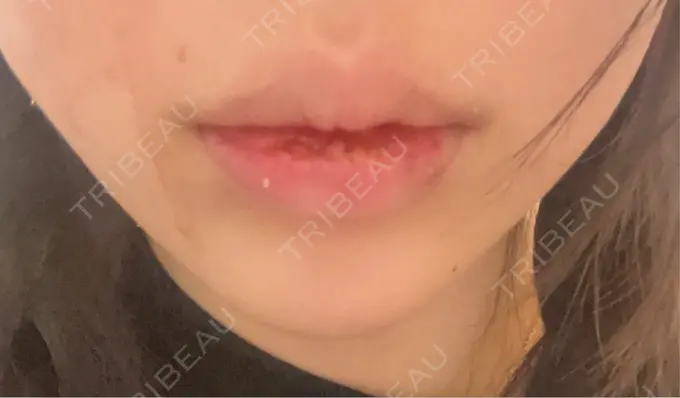 口唇縮小術 B-LINE CLINIC 池袋院 DAY 6 メイン用