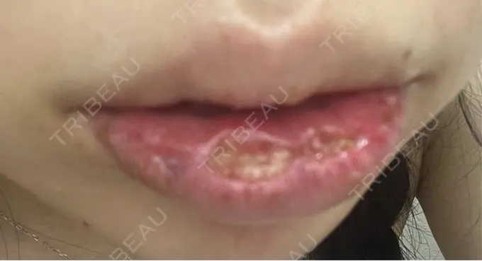 口唇縮小術 B-LINE CLINIC 池袋院 DAY 7 メイン用