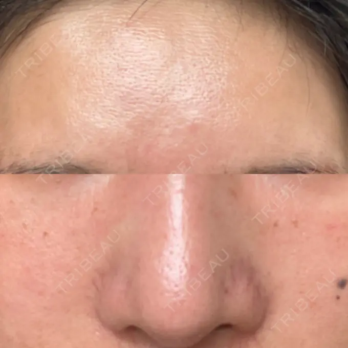 マイクロボトックス 東京シルククリニック 新宿院 AFTER メイン用