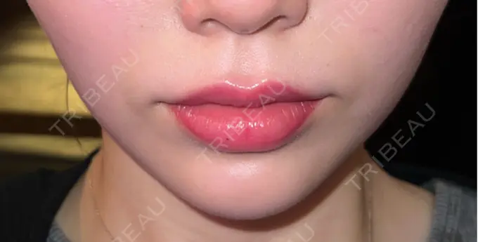 ボトックス（口角） ルラ美容クリニック 広島院 DAY 2 メイン用