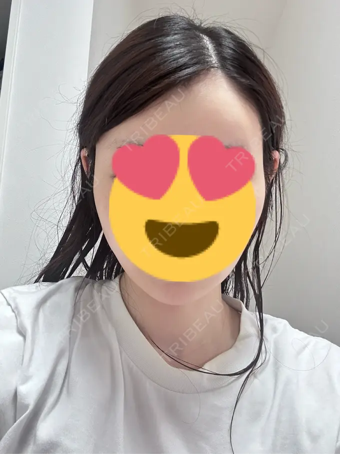 糸リフト / 脂肪吸引（顔） Mods Clinic（モッズクリニック） 名古屋院 DAY 91 メイン用