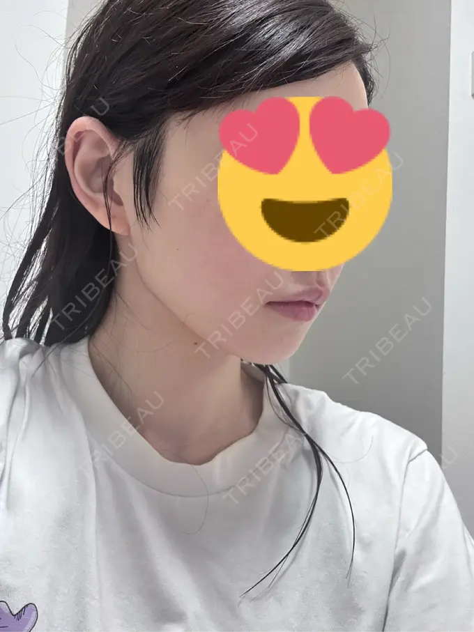 糸リフト / 脂肪吸引（顔） Mods Clinic（モッズクリニック） 名古屋院 DAY 91 メイン用