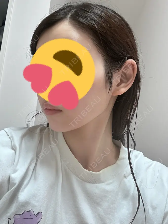 糸リフト / 脂肪吸引（顔） Mods Clinic（モッズクリニック） 名古屋院 DAY 91 メイン用