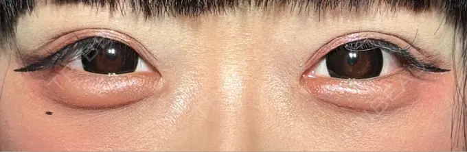 二重埋没 / ヒアルロン酸注入（涙袋） アリエル美容クリニック 横浜院 AFTER メイン用