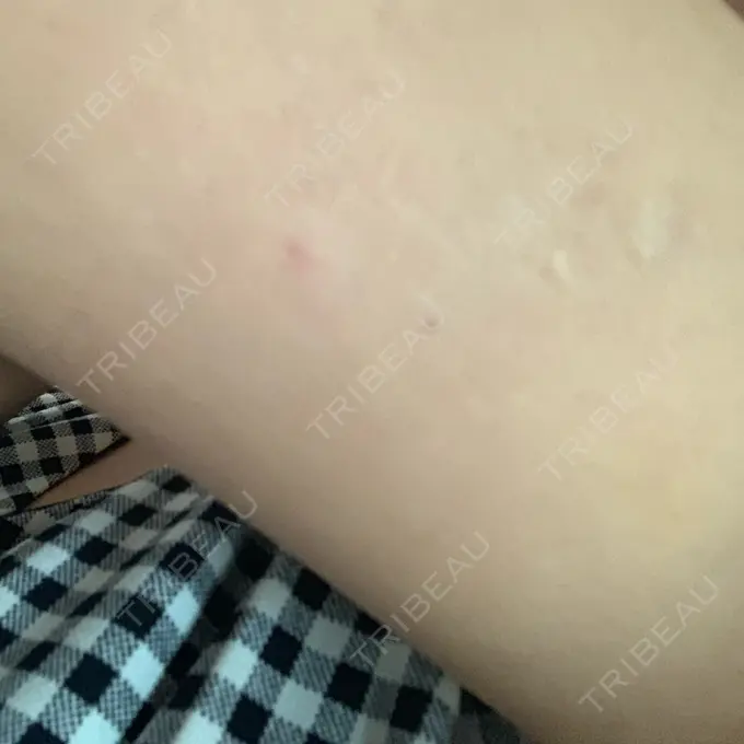 脂肪溶解注射（二の腕） / その他（ボディ） チョンダムジュエンクリニック DAY 7 メイン用